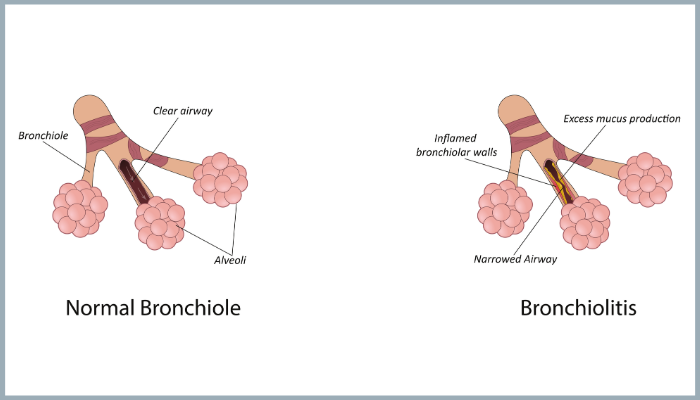 20260218_KHI_Bronchiolitis_Illustration2
